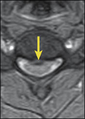Upright Dynamic MRI Reveals Hidden Disc Herniation