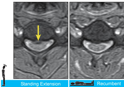 Case #3: Upright Dynamic MRI Reveals Hidden Disc Herniation